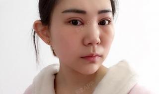 武汉双眼皮 武汉双眼皮